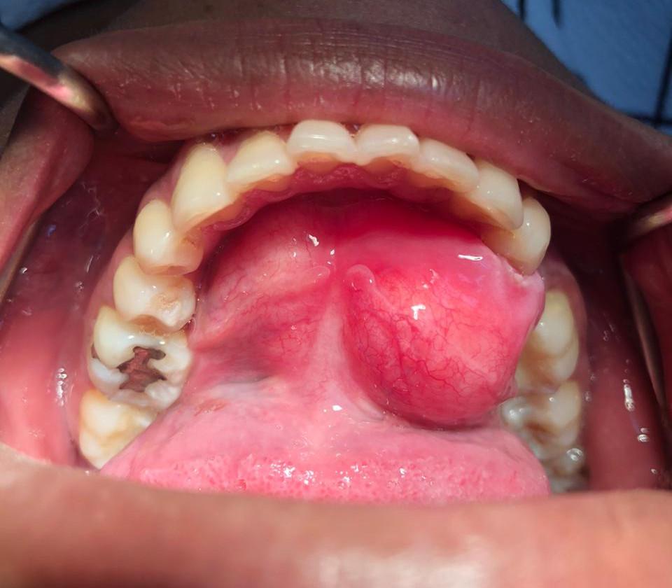 antes Cirugía de lipoma Bucal
